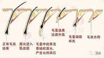 強脈沖脫毛技術與單部位色素沉著的機制解析——以劉亦菲“黑部”輿情為例